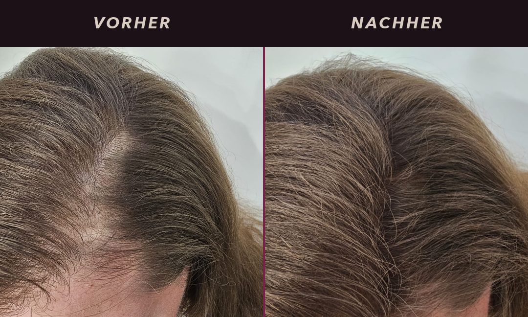 Haarverdichtung am Ansatz bei einer Frau mit braunem Haar: vorher deutlich sichtbare Kopfhaut entlang des Scheitels, nachher gleichmäßige Dichte bis zur Haarlinie