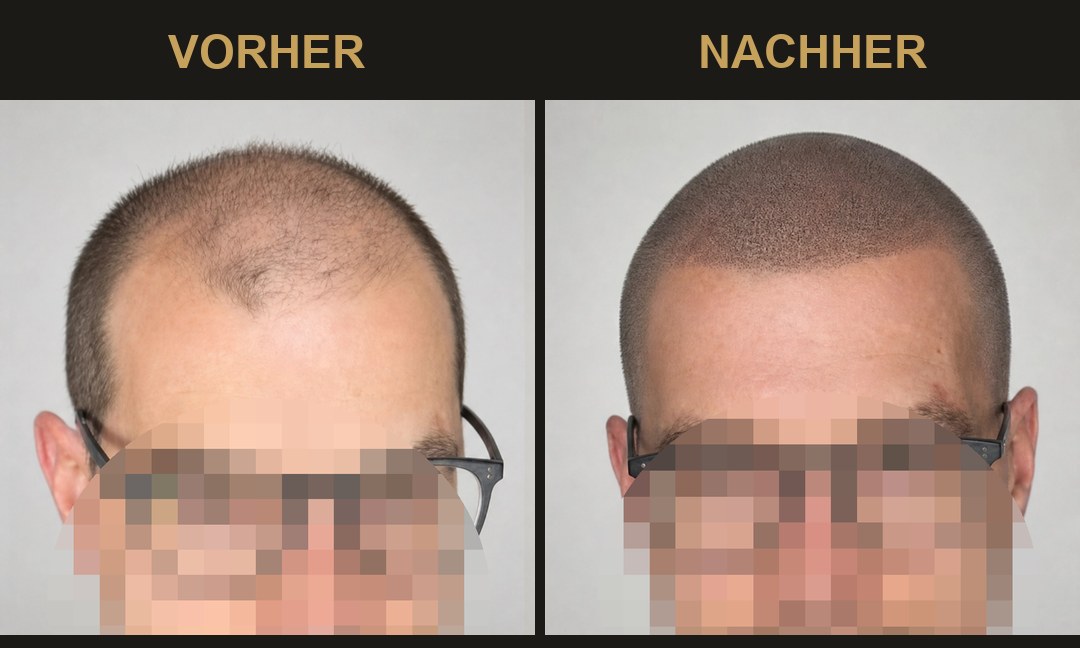 SMP Vorher-Nachher: links lichter werdendes Haar, rechts definierte Haarlinie und volle Haardichte